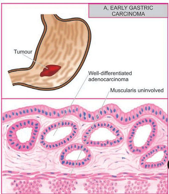 Gastric carcinoma