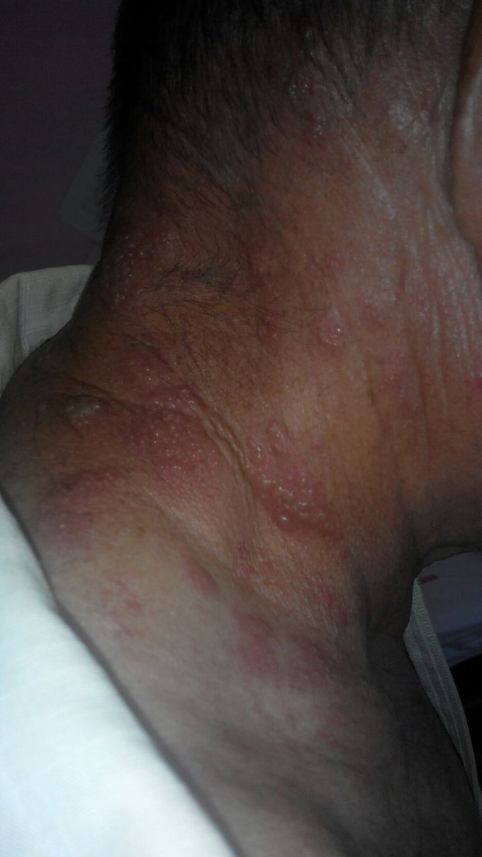 Herpes zoster