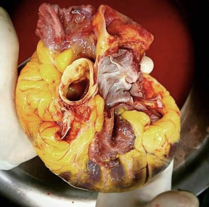 heart
