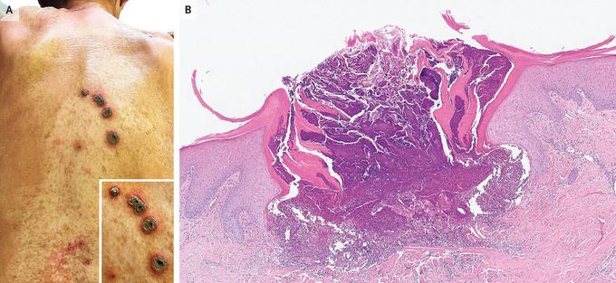 Acquired Reactive Perforating Collagenosis