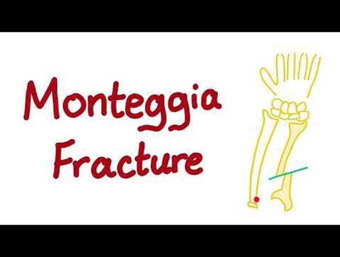 Monteggia Fracture