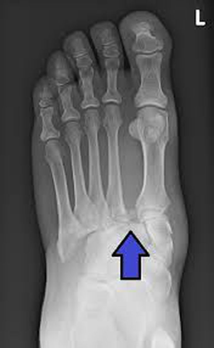 Tests for diagnosing lisfranc injury