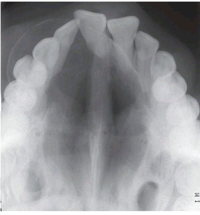 Adenomatoid odontogenic tumour