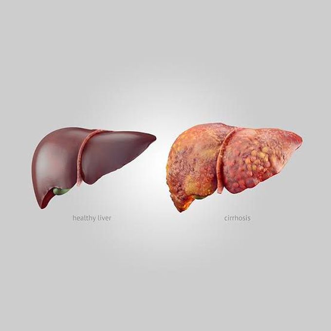 Treatment of cirrhosis