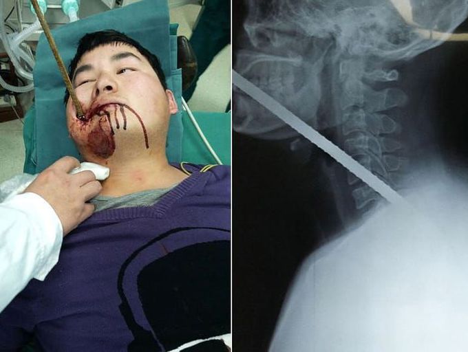 Builder with metal rod impaled through his mouth!