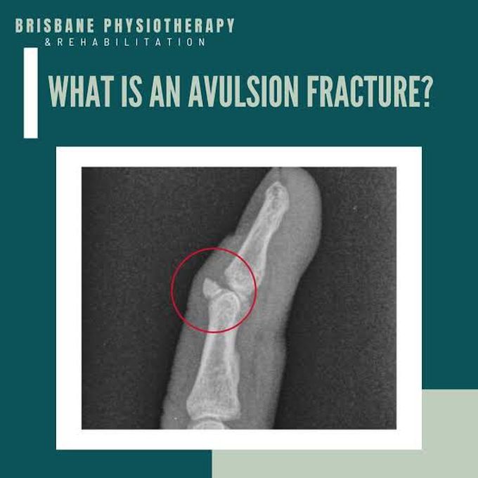 What is an avulsion fracture?