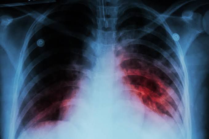 Treatment of TB