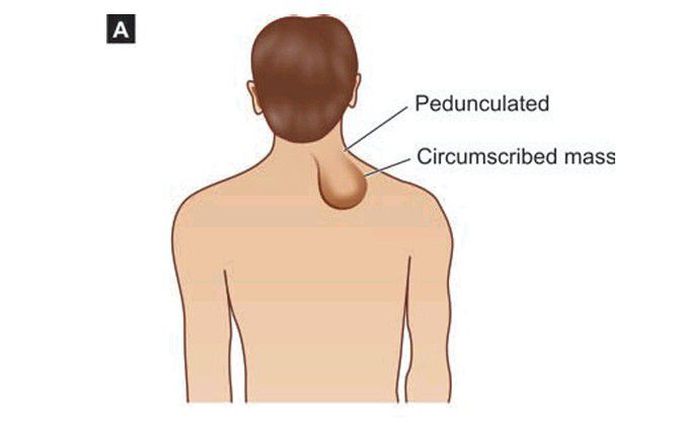 Lipoma