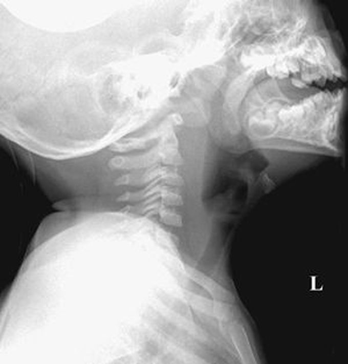 Retropharyngeal Abscess: A Potentially Dangerous Condition