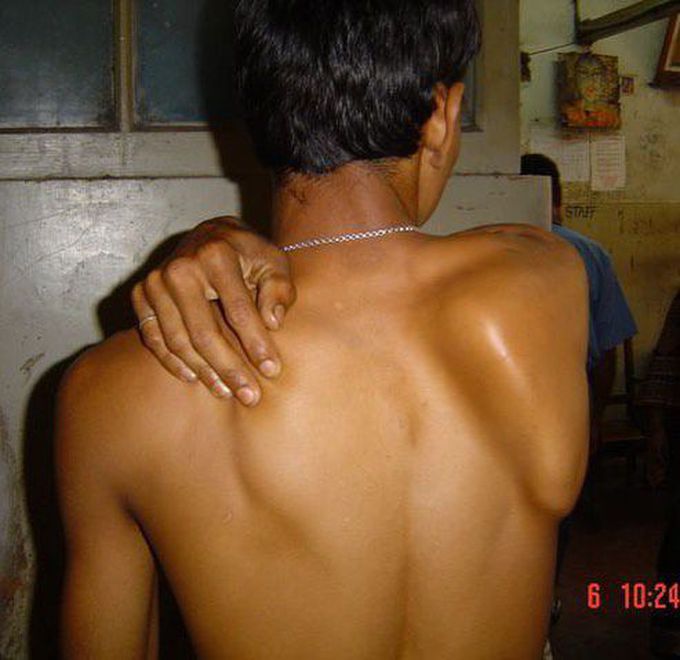 Which nerve is injured in this condition??