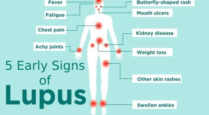 Early signs of lupus - MEDizzy