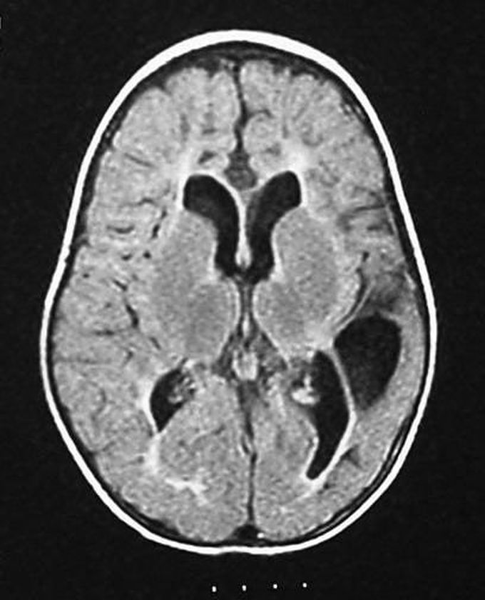 Cerebral Palsy