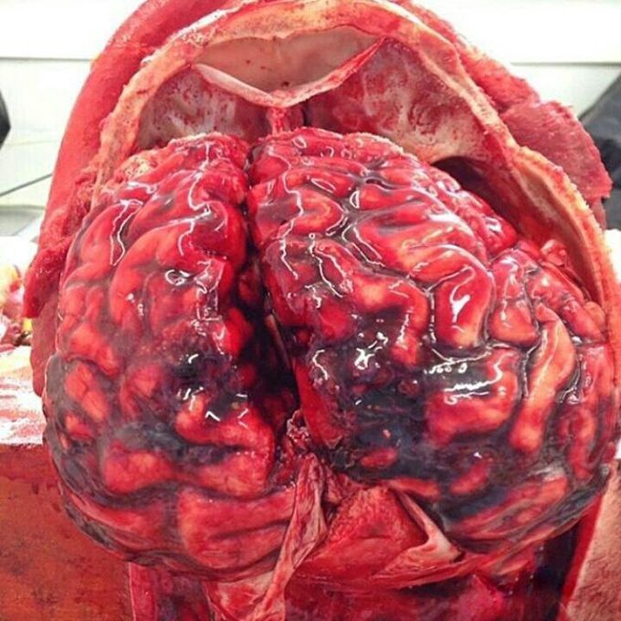 Sub arachnoid haemorrhage!!