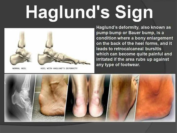 Haglund's Sign