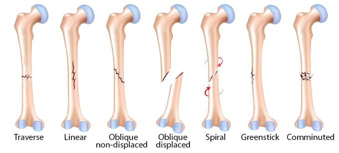 Types of Bone Fractures