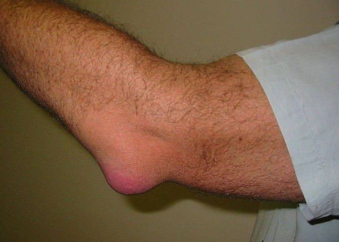 Olecranon bursitis
