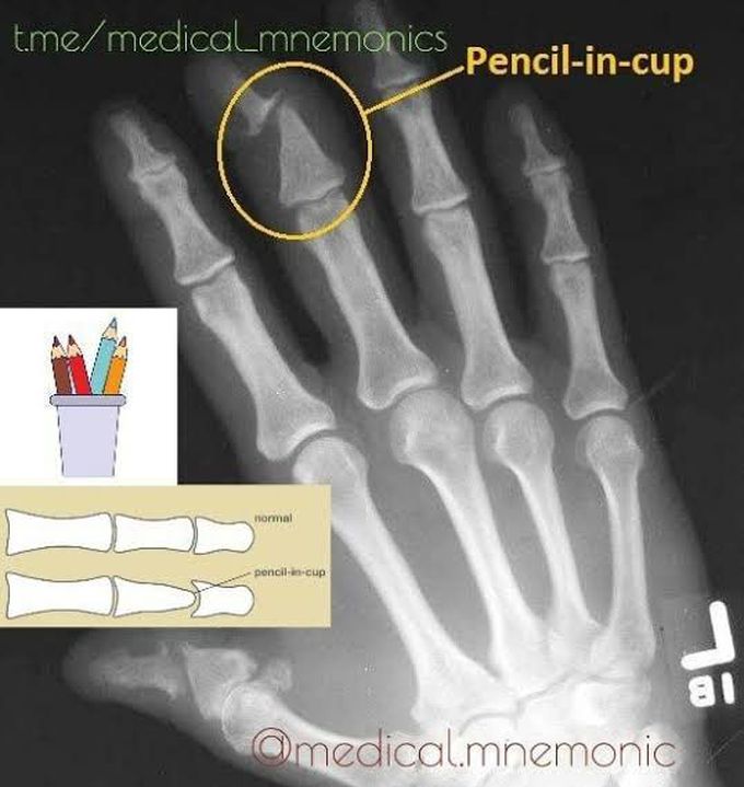 pencil-in-cup-deformity-medizzy