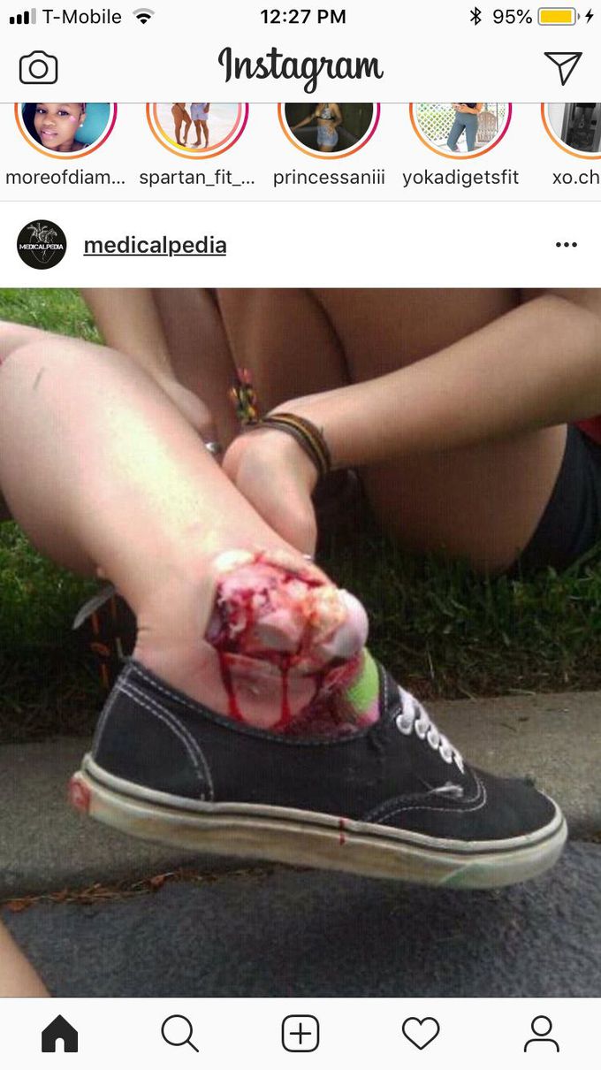 Broken ankle by skateboarding they are a result of severe trauma