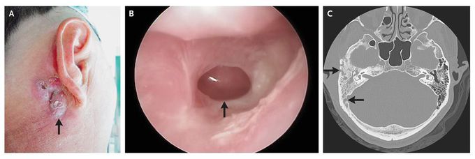 Mastoiditis