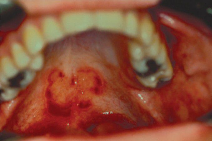 Ectopic geographic tongue