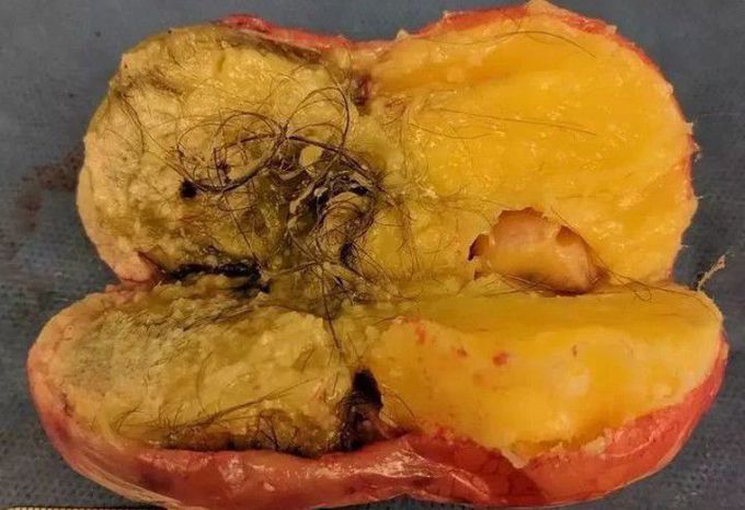 An Ovarian Cyst