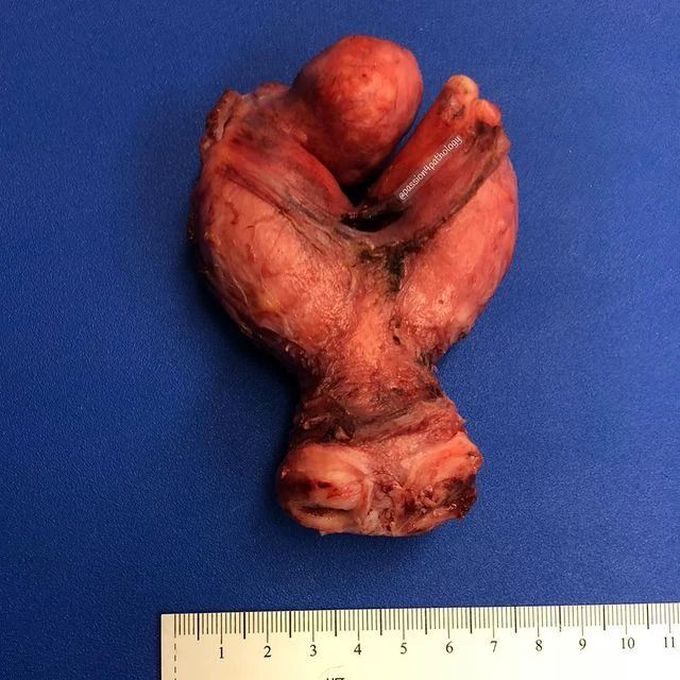 Heart shaped Uterus