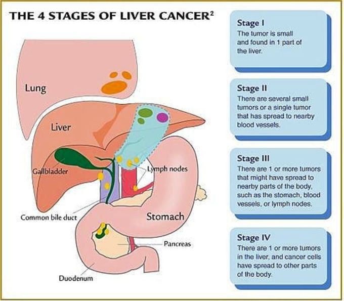 Stages of  liver cancer