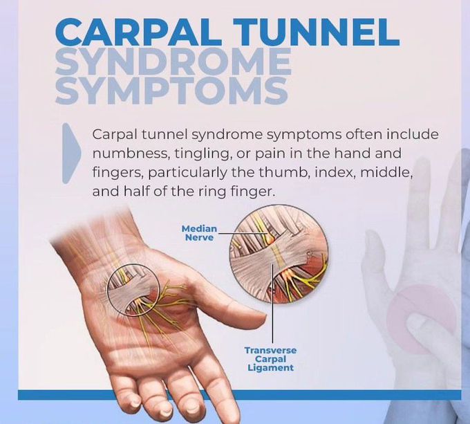 Carpal Tunnel Syndrome