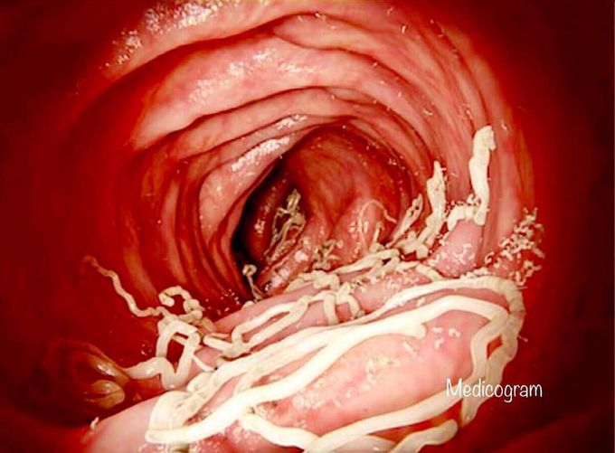 Illustration of an intestinal infection, Ascariasis. 