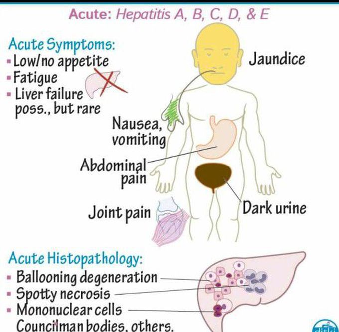 Hepatitis symptoms
