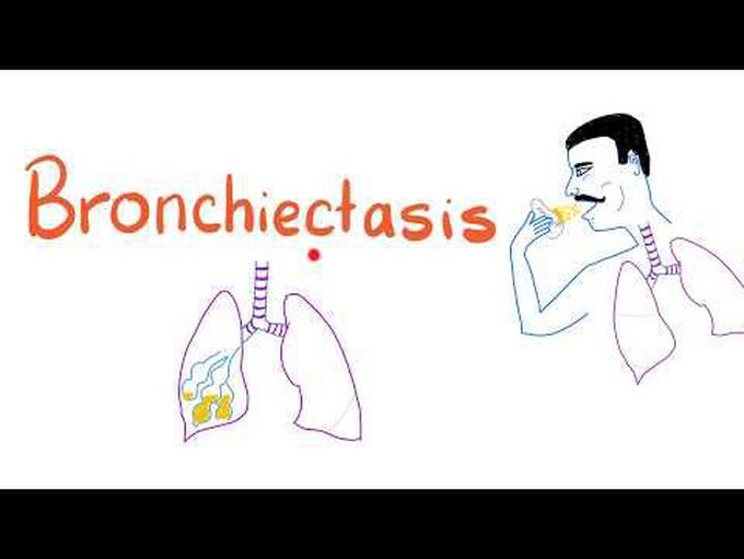 Brief study of Bronchiectasis