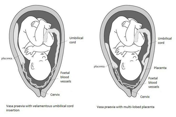 Types of Vasa Praevia