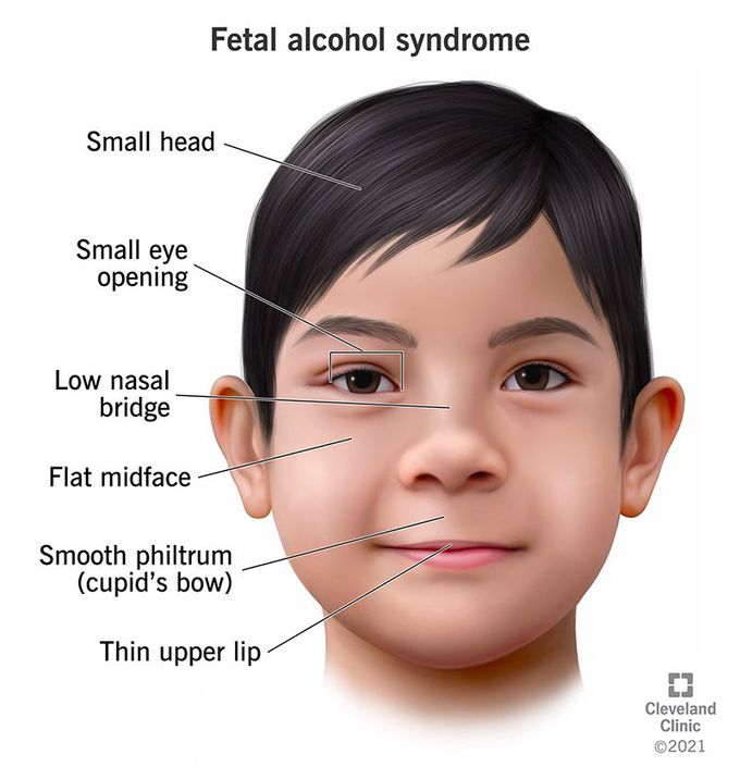 Fetal Alcohol Syndrome (FAS)