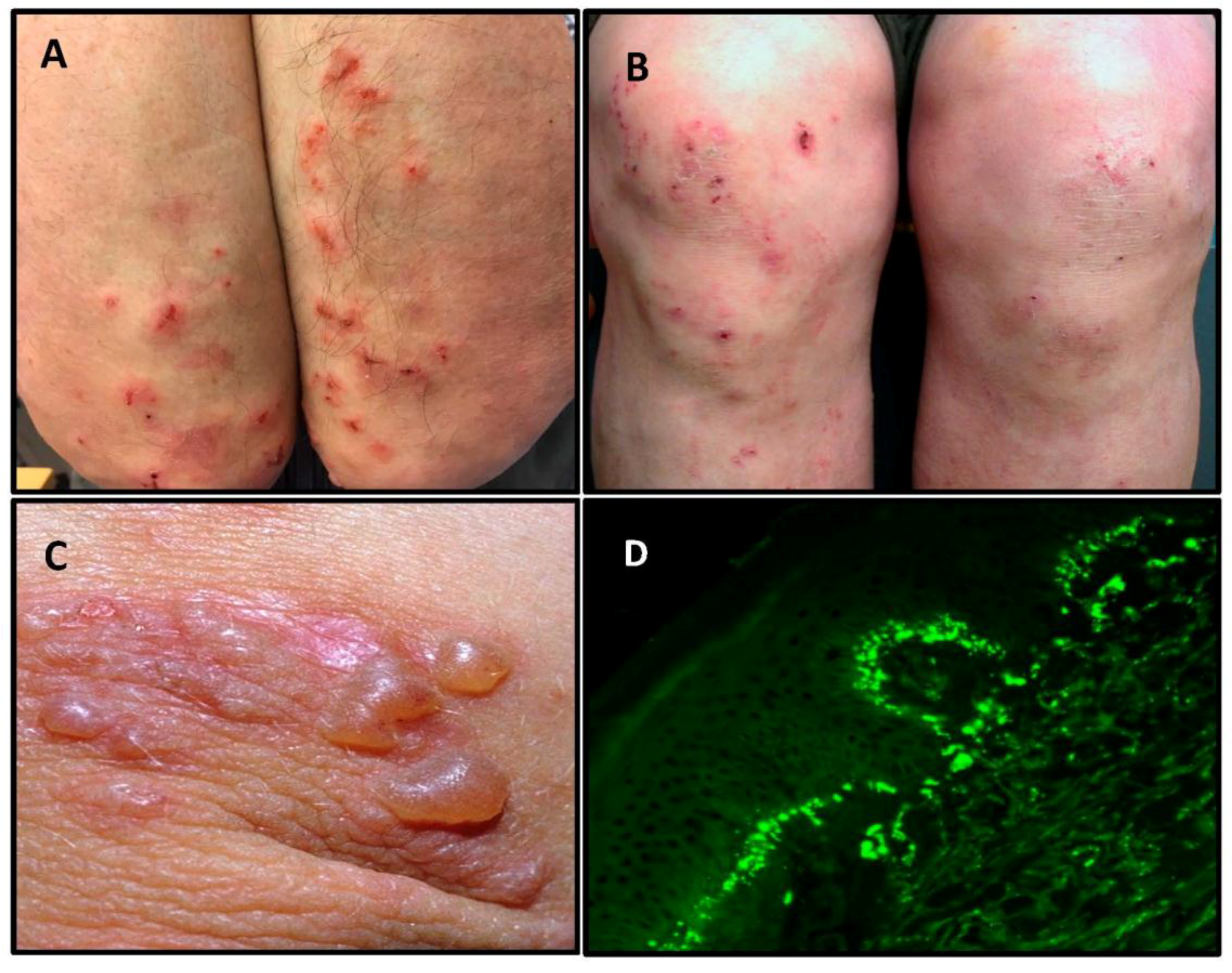 dermatitis herpetiformis neck