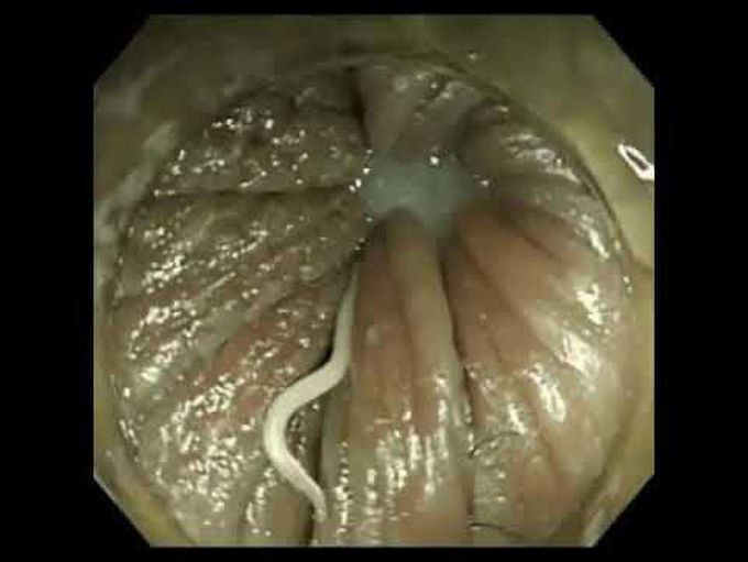 Enterobius vermicularis(Pinworm) Infection