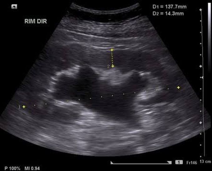 Cause of hydronephrosis