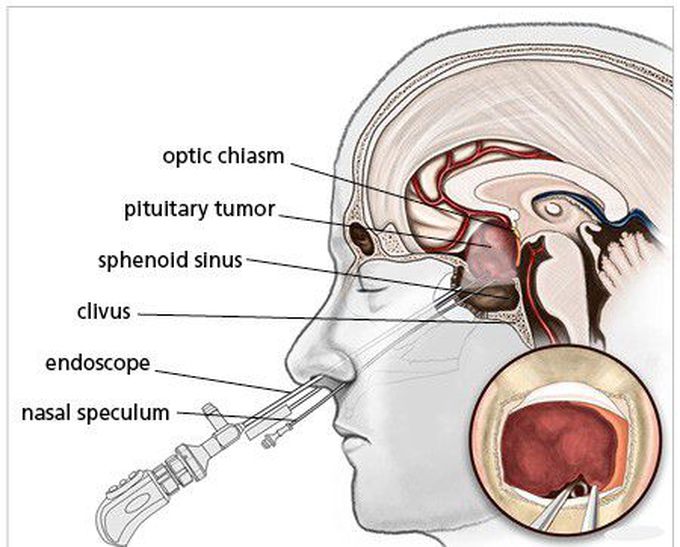 Acromegaly - Treatment