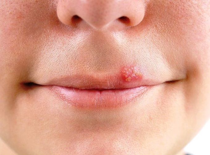 #herpes