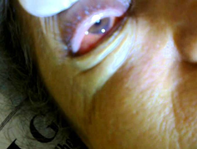Granulocytic sarcoma (Chloroma)