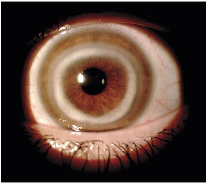 Interstitial Keratitis in Cogan’s Syndrome