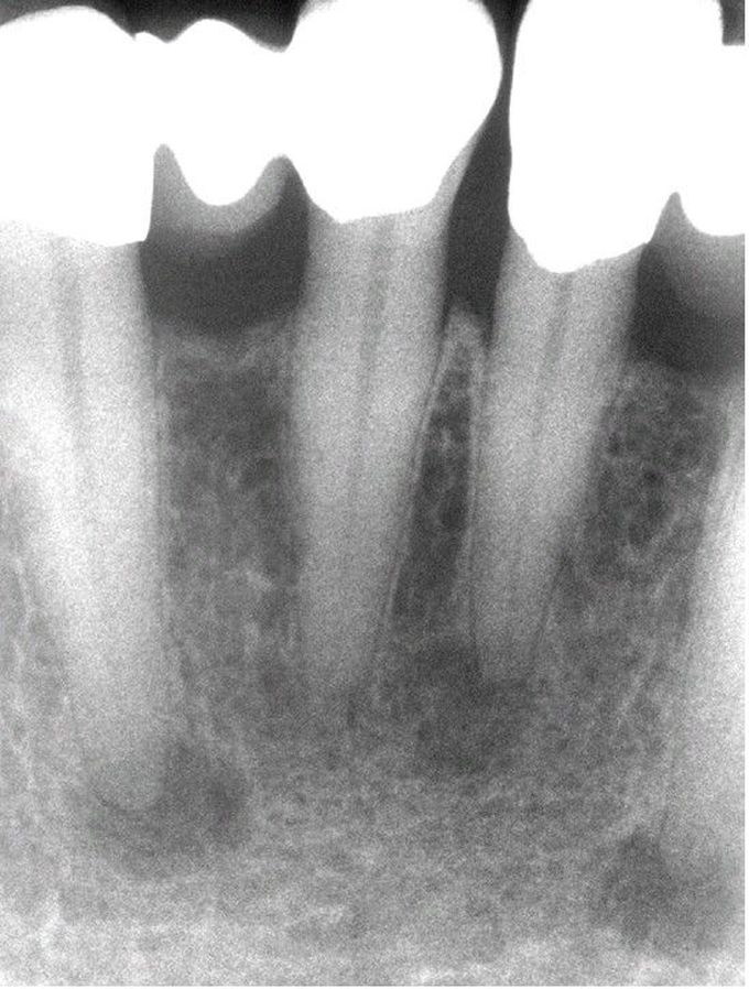 Periapical Cemento-Osseous Dysplasia.