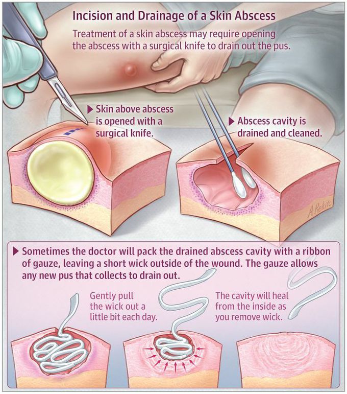 Skin abscess