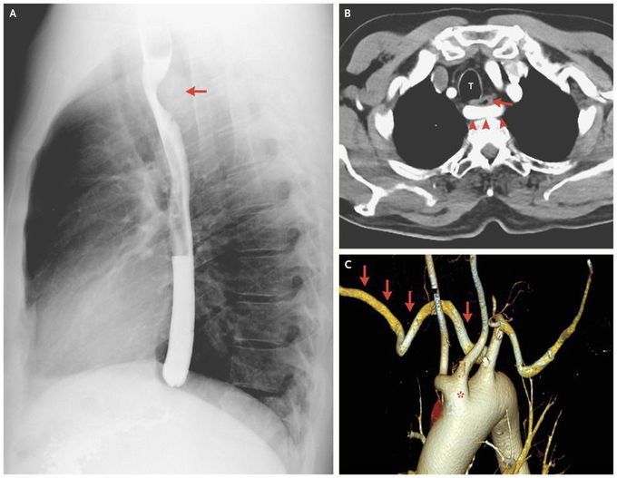 Dysphagia Lusoria