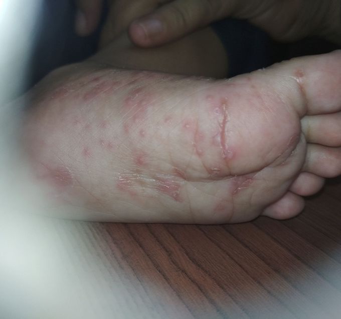 Dermatology