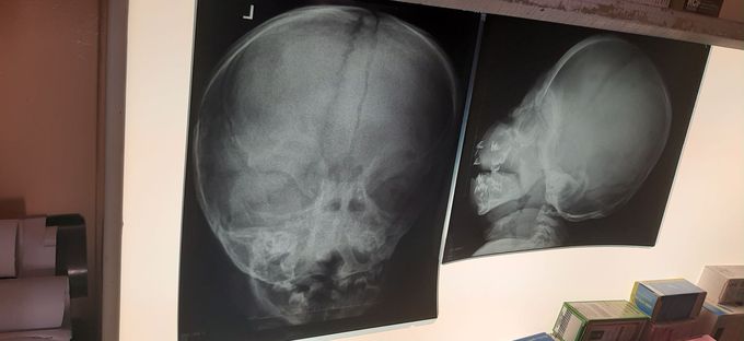 Juvenile hayline fibramatosis