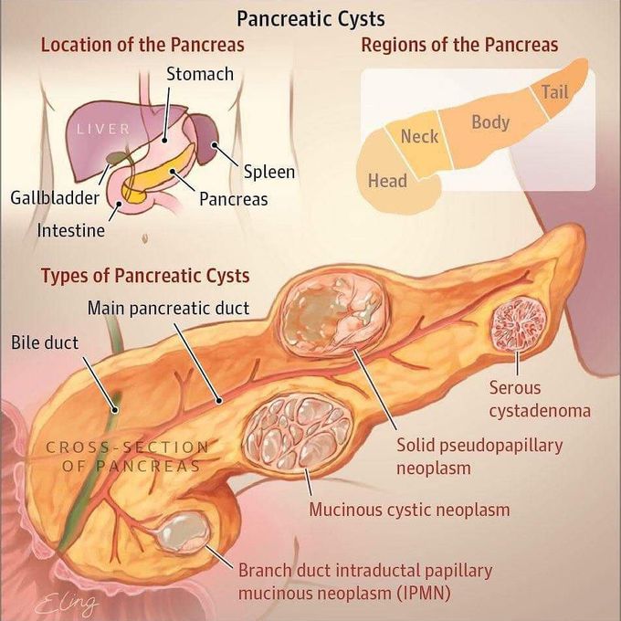 Is A 4 Cm Pancreatic Cyst Big