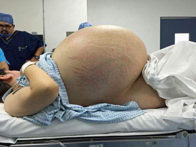 Life threatening tumors