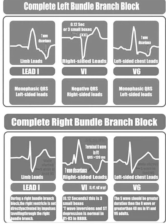 Bundle Branch Block