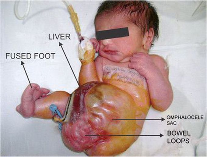 Omphalocele