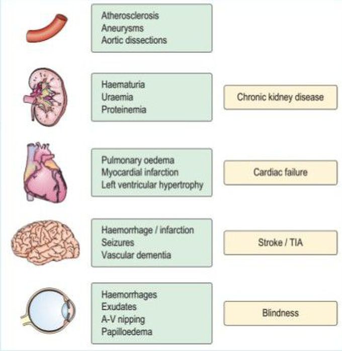 Complications of Hypertension